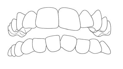 おのデンタルクリニック　インビザライン