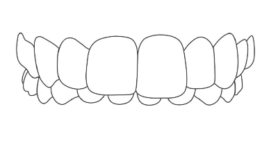 おのデンタルクリニック　インビザライン